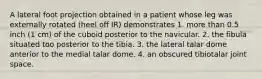 A lateral foot projection obtained in a patient whose leg was externally rotated (heel off IR) demonstrates 1. more than 0.5 inch (1 cm) of the cuboid posterior to the navicular. 2. the fibula situated too posterior to the tibia. 3. the lateral talar dome anterior to the medial talar dome. 4. an obscured tibiotalar joint space.