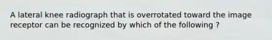 A lateral knee radiograph that is overrotated toward the image receptor can be recognized by which of the following ?