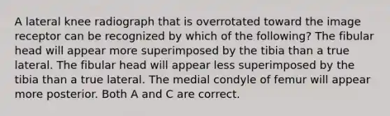 A lateral knee radiograph that is overrotated toward the image receptor can be recognized by which of the following? The fibular head will appear more superimposed by the tibia than a true lateral. The fibular head will appear less superimposed by the tibia than a true lateral. The medial condyle of femur will appear more posterior. Both A and C are correct.