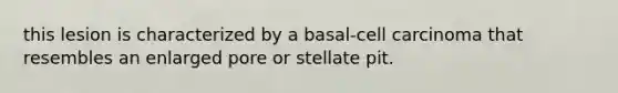 this lesion is characterized by a basal-cell carcinoma that resembles an enlarged pore or stellate pit.