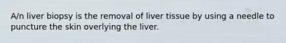 A/n liver biopsy is the removal of liver tissue by using a needle to puncture the skin overlying the liver.