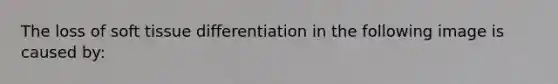 The loss of soft tissue differentiation in the following image is caused by: