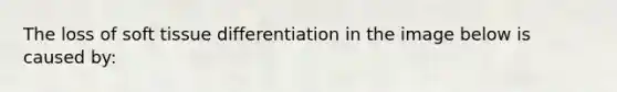 The loss of soft tissue differentiation in the image below is caused by: