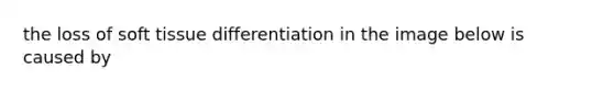 the loss of soft tissue differentiation in the image below is caused by