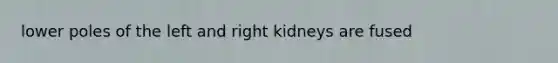 lower poles of the left and right kidneys are fused