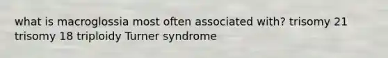 what is macroglossia most often associated with? trisomy 21 trisomy 18 triploidy Turner syndrome