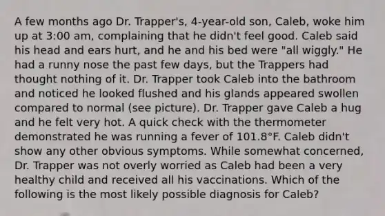 A few months ago Dr. Trapper's, 4-year-old son, Caleb, woke him up at 3:00 am, complaining that he didn't feel good. Caleb said his head and ears hurt, and he and his bed were "all wiggly." He had a runny nose the past few days, but the Trappers had thought nothing of it. Dr. Trapper took Caleb into the bathroom and noticed he looked flushed and his glands appeared swollen compared to normal (see picture). Dr. Trapper gave Caleb a hug and he felt very hot. A quick check with the thermometer demonstrated he was running a fever of 101.8°F. Caleb didn't show any other obvious symptoms. While somewhat concerned, Dr. Trapper was not overly worried as Caleb had been a very healthy child and received all his vaccinations. Which of the following is the most likely possible diagnosis for Caleb?