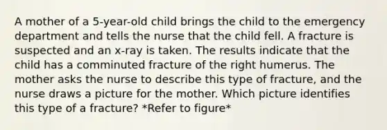 A mother of a 5-year-old child brings the child to the emergency department and tells the nurse that the child fell. A fracture is suspected and an x-ray is taken. The results indicate that the child has a comminuted fracture of the right humerus. The mother asks the nurse to describe this type of fracture, and the nurse draws a picture for the mother. Which picture identifies this type of a fracture? *Refer to figure*