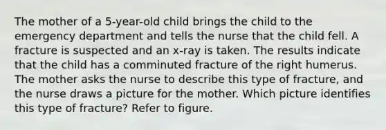 The mother of a 5-year-old child brings the child to the emergency department and tells the nurse that the child fell. A fracture is suspected and an x-ray is taken. The results indicate that the child has a comminuted fracture of the right humerus. The mother asks the nurse to describe this type of fracture, and the nurse draws a picture for the mother. Which picture identifies this type of fracture? Refer to figure.