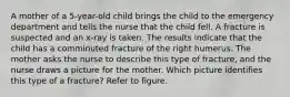 A mother of a 5-year-old child brings the child to the emergency department and tells the nurse that the child fell. A fracture is suspected and an x-ray is taken. The results indicate that the child has a comminuted fracture of the right humerus. The mother asks the nurse to describe this type of fracture, and the nurse draws a picture for the mother. Which picture identifies this type of a fracture? Refer to figure.