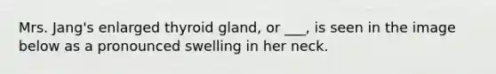 Mrs. Jang's enlarged thyroid gland, or ___, is seen in the image below as a pronounced swelling in her neck.