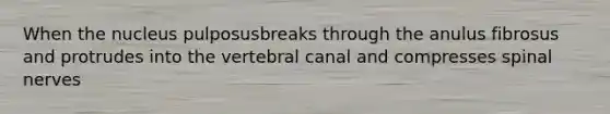 When the nucleus pulposusbreaks through the anulus fibrosus and protrudes into the vertebral canal and compresses spinal nerves