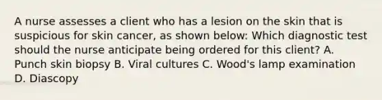 A nurse assesses a client who has a lesion on the skin that is suspicious for skin cancer, as shown below: Which diagnostic test should the nurse anticipate being ordered for this client? A. Punch skin biopsy B. Viral cultures C. Wood's lamp examination D. Diascopy