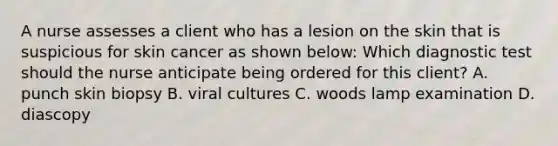 A nurse assesses a client who has a lesion on the skin that is suspicious for skin cancer as shown below: Which diagnostic test should the nurse anticipate being ordered for this client? A. punch skin biopsy B. viral cultures C. woods lamp examination D. diascopy
