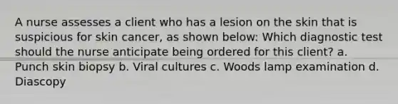 A nurse assesses a client who has a lesion on the skin that is suspicious for skin cancer, as shown below: Which diagnostic test should the nurse anticipate being ordered for this client? a. Punch skin biopsy b. Viral cultures c. Woods lamp examination d. Diascopy