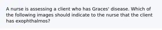 A nurse is assessing a client who has Graces' disease. Which of the following images should indicate to the nurse that the client has exophthalmos?