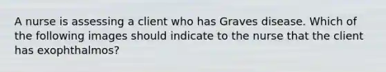 A nurse is assessing a client who has Graves disease. Which of the following images should indicate to the nurse that the client has exophthalmos?