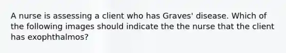 A nurse is assessing a client who has Graves' disease. Which of the following images should indicate the the nurse that the client has exophthalmos?