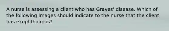 A nurse is assessing a client who has Graves' disease. Which of the following images should indicate to the nurse that the client has exophthalmos?