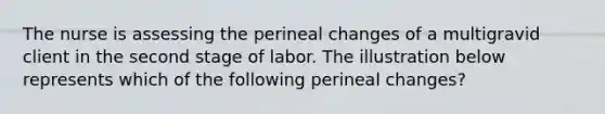 The nurse is assessing the perineal changes of a multigravid client in the second stage of labor. The illustration below represents which of the following perineal changes?