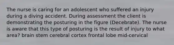 The nurse is caring for an adolescent who suffered an injury during a diving accident. During assessment the client is demonstrating the posturing in the figure (Decebrate). The nurse is aware that this type of posturing is the result of injury to what area? brain stem cerebral cortex frontal lobe mid-cervical