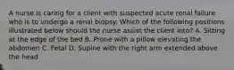 A nurse is caring for a client with suspected acute renal failure who is to undergo a renal biopsy. Which of the following positions illustrated below should the nurse assist the client into? A. Sitting at the edge of the bed B. Prone with a pillow elevating the abdomen C. Fetal D. Supine with the right arm extended above the head