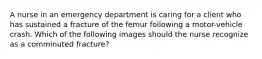 A nurse in an emergency department is caring for a client who has sustained a fracture of the femur following a motor-vehicle crash. Which of the following images should the nurse recognize as a comminuted fracture?