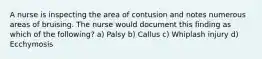 A nurse is inspecting the area of contusion and notes numerous areas of bruising. The nurse would document this finding as which of the following? a) Palsy b) Callus c) Whiplash injury d) Ecchymosis