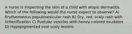 A nurse is inspecting the skin of a child with atopic dermatitis. Which of the following would the nurse expect to observe? A) Erythematous papulovesicular rash B) Dry, red, scaly rash with lichenification C) Pustular vesicles with honey-colored exudates D) Hypopigmented oval scaly lesions