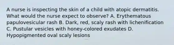 A nurse is inspecting the skin of a child with atopic dermatitis. What would the nurse expect to observe? A. Erythematous papulovesicular rash B. Dark, red, scaly rash with lichenification C. Pustular vesicles with honey-colored exudates D. Hypopigmented oval scaly lesions