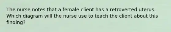 The nurse notes that a female client has a retroverted uterus. Which diagram will the nurse use to teach the client about this finding?