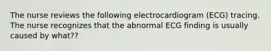 The nurse reviews the following electrocardiogram (ECG) tracing. The nurse recognizes that the abnormal ECG finding is usually caused by what??