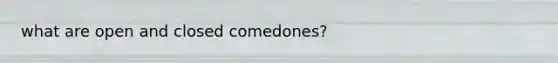 what are open and closed comedones?