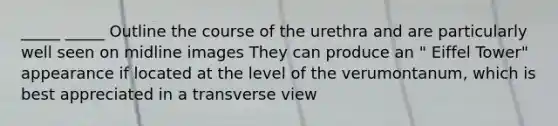 _____ _____ Outline the course of the urethra and are particularly well seen on midline images They can produce an " Eiffel Tower" appearance if located at the level of the verumontanum, which is best appreciated in a transverse view