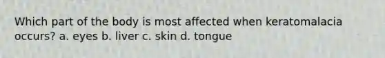 Which part of the body is most affected when keratomalacia occurs? a. eyes b. liver c. skin d. tongue