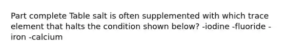 Part complete Table salt is often supplemented with which trace element that halts the condition shown below? -iodine -fluoride -iron -calcium