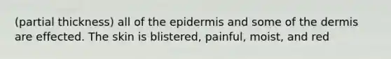 (partial thickness) all of the epidermis and some of the dermis are effected. The skin is blistered, painful, moist, and red