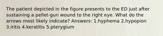 The patient depicted in the figure presents to the ED just after sustaining a pellet-gun wound to the right eye. What do the arrows most likely indicate? Answers: 1.hyphema 2.hypopion 3.iritis 4.keratitis 5.pterygium