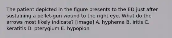 The patient depicted in the figure presents to the ED just after sustaining a pellet-gun wound to the right eye. What do the arrows most likely indicate? [image] A. hyphema B. iritis C. keratitis D. pterygium E. hypopion