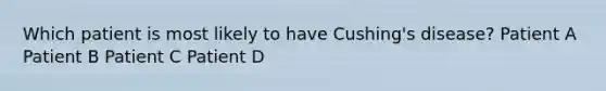 Which patient is most likely to have Cushing's disease? Patient A Patient B Patient C Patient D