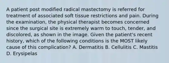 A patient post modified radical mastectomy is referred for treatment of associated soft tissue restrictions and pain. During the examination, the physical therapist becomes concerned since the surgical site is extremely warm to touch, tender, and discolored, as shown in the image. Given the patient's recent history, which of the following conditions is the MOST likely cause of this complication? A. Dermatitis B. Cellulitis C. Mastitis D. Erysipelas