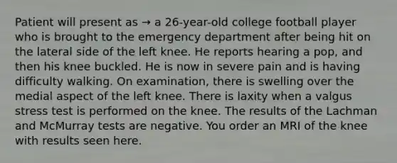 Patient will present as → a 26-year-old college football player who is brought to the emergency department after being hit on the lateral side of the left knee. He reports hearing a pop, and then his knee buckled. He is now in severe pain and is having difficulty walking. On examination, there is swelling over the medial aspect of the left knee. There is laxity when a valgus stress test is performed on the knee. The results of the Lachman and McMurray tests are negative. You order an MRI of the knee with results seen here.