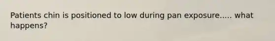 Patients chin is positioned to low during pan exposure..... what happens?