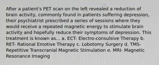 After a patient's PET scan on the left revealed a reduction of brain activity, commonly found in patients suffering depression, their psychiatrist prescribed a series of sessions where they would receive a repeated magnetic energy to stimulate brain activity and hopefully reduce their symptoms of depression. This treatment is known as... a. ECT- Electro-consulsive Therapy b. RET- Rational Emotive Therapy c. Lobotomy Surgery d. TMS- Repetitive Transcranial Magnetic Stimulation e. MRI- Magnetic Resonance Imaging