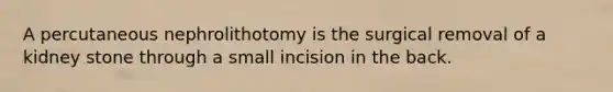 A percutaneous nephrolithotomy is the surgical removal of a kidney stone through a small incision in the back.