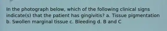 In the photograph below, which of the following clinical signs indicate(s) that the patient has gingivitis? a. Tissue pigmentation b. Swollen marginal tissue c. Bleeding d. B and C