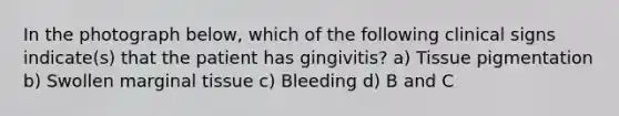 In the photograph below, which of the following clinical signs indicate(s) that the patient has gingivitis? a) Tissue pigmentation b) Swollen marginal tissue c) Bleeding d) B and C