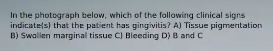 In the photograph below, which of the following clinical signs indicate(s) that the patient has gingivitis? A) Tissue pigmentation B) Swollen marginal tissue C) Bleeding D) B and C