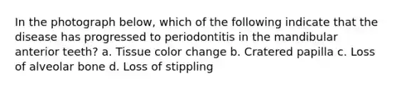 In the photograph below, which of the following indicate that the disease has progressed to periodontitis in the mandibular anterior teeth? a. Tissue color change b. Cratered papilla c. Loss of alveolar bone d. Loss of stippling