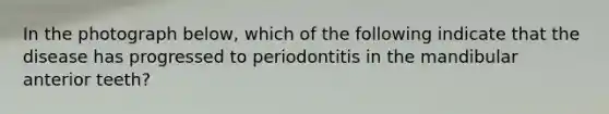 In the photograph below, which of the following indicate that the disease has progressed to periodontitis in the mandibular anterior teeth?